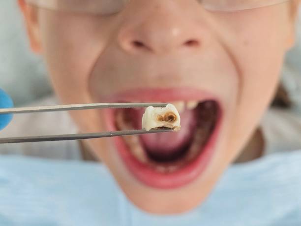 Best Emergency Tooth Extraction in La Presa, CA